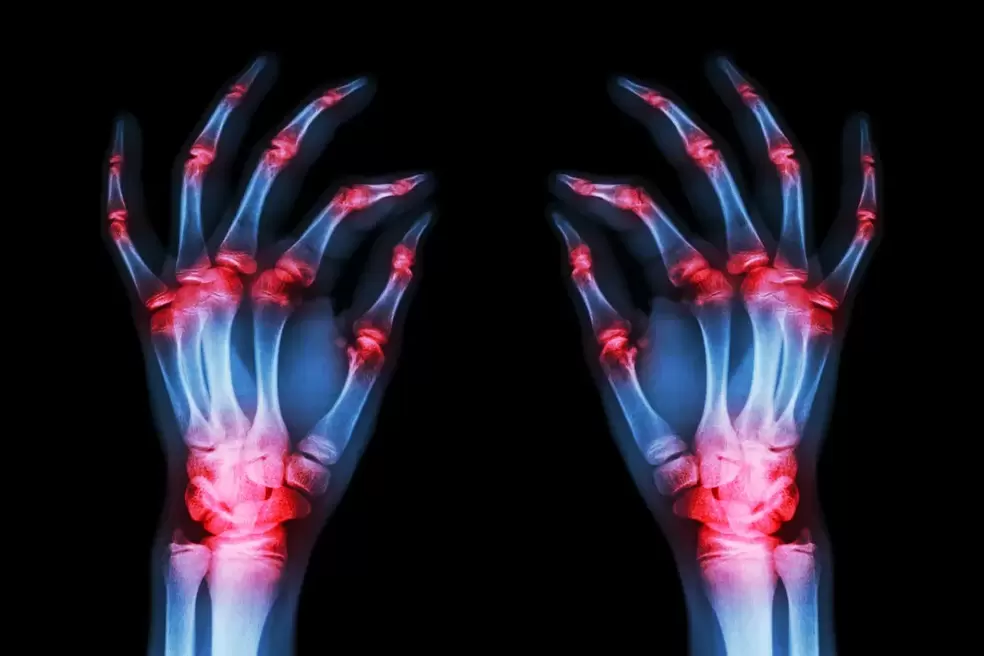 artróza kloubů prstů