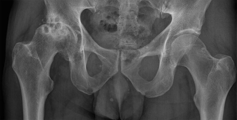 3. stadium artrózy kyčelního kloubu na rentgenu