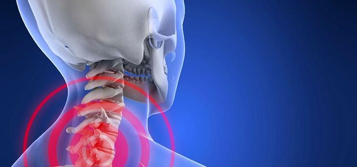 Osteochondroza v oblasti děložního čípku