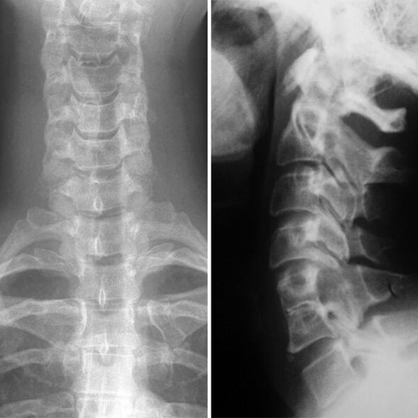 X -ray z krční páteře