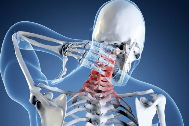 Osteochondroza v oblasti děložního čípku