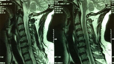 MRI oddělení děložního čípku
