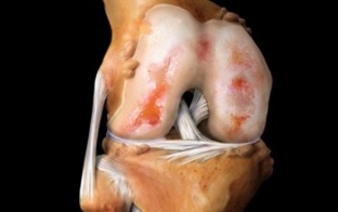 co je artróza kolena