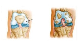patologické změny v artróze kolena