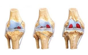 stadia artrózy kolenního kloubu