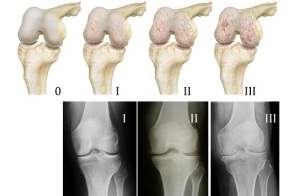 metody diagnostiky artrózy kolena