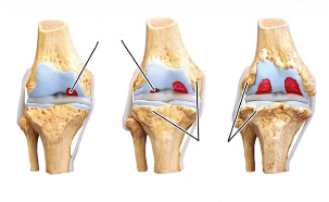 stadia artrózy kolena