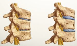 jak vypadá osteochondróza