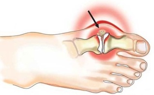 Zánět kloubu mezi palcem a nohou při artritidě