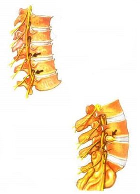 ilustrace osteochondrózy páteře