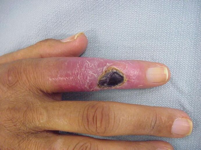 osteomyelitida jako příčina bolesti v kloubech prstů
