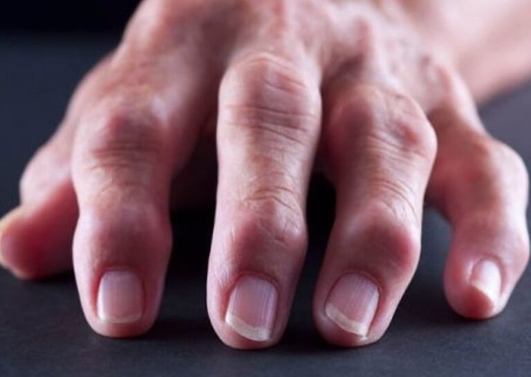 revmatoidní artritida jako příčina bolesti v kloubech prstů