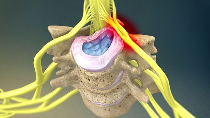 Protruze meziobratlové ploténky je příčinou bolesti krku